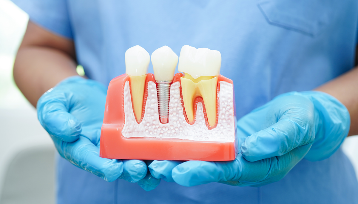 WhatAreDentalImplantsblog.png